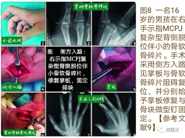 Key Points in the Diagnosis and Treatment of Metacarpophalangeal Joint Dislocation