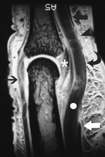 MRI of Finger Tendons