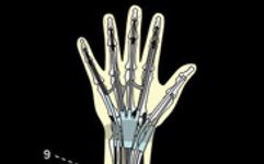 MRI of Finger Tendons