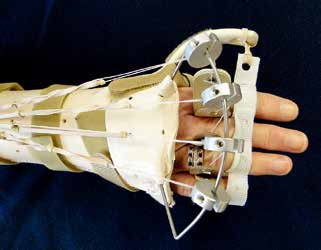 MCP And PIP Joint Arthroplasty - AAOS Orthopedic Postoperative Rehabilitation Guidelines