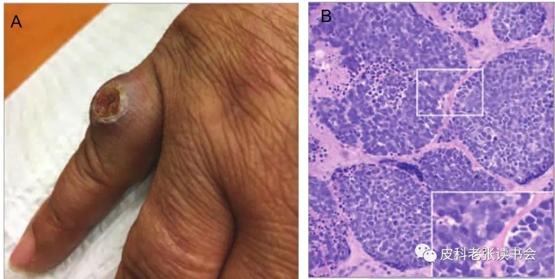 Merkel Cell Carcinoma Is Not Derived From Merkel Cells!
