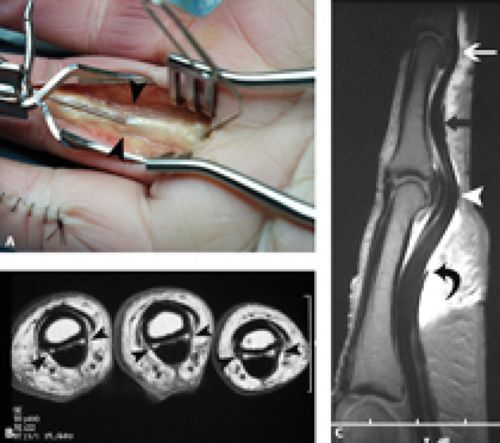 MRI of Finger Tendons