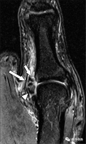 Latest Review: MRI Diagnostic Techniques for Little Finger and Thumb