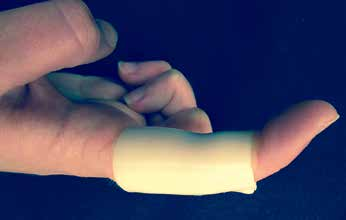 MCP And PIP Joint Arthroplasty - AAOS Orthopedic Postoperative Rehabilitation Guidelines