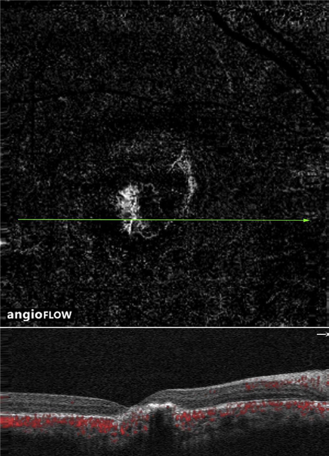 Understanding Multifocal Choroiditis Through Angio-OCT