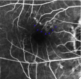 Understanding Multifocal Choroiditis Through Angio-OCT