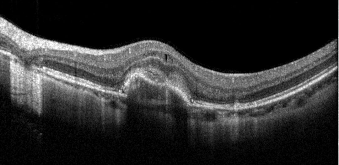 Understanding Multifocal Choroiditis Through Angio-OCT