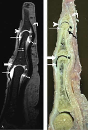 MRI of Finger Tendons