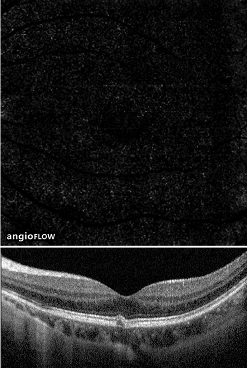 Understanding Multifocal Choroiditis Through Angio-OCT