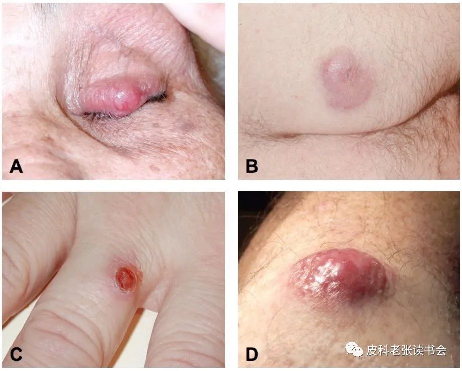 Merkel Cell Carcinoma Is Not Derived From Merkel Cells!