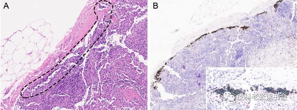 Merkel Cell Carcinoma Is Not Derived From Merkel Cells!