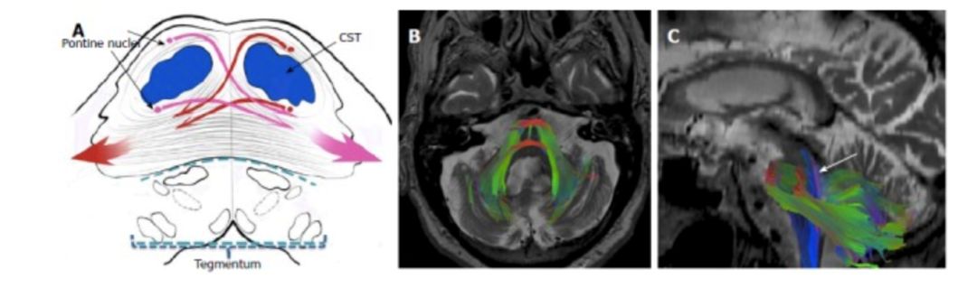 Exploring the Mystery of Middle Cerebellar Peduncles