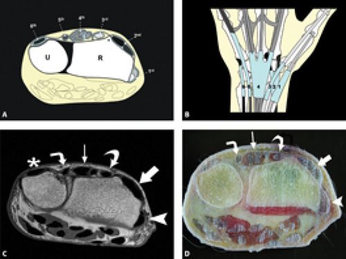 MRI of Finger Tendons