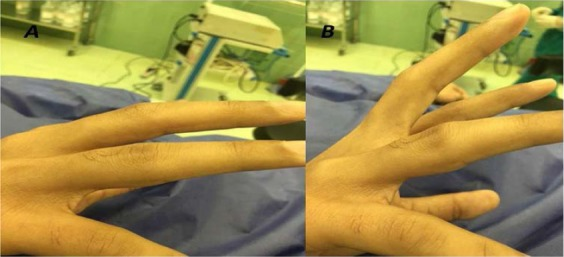 Key Points of Three Types of Hand Joint Injuries