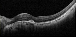Understanding Multifocal Choroiditis Through Angio-OCT