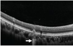 Understanding Multifocal Choroiditis Through Angio-OCT