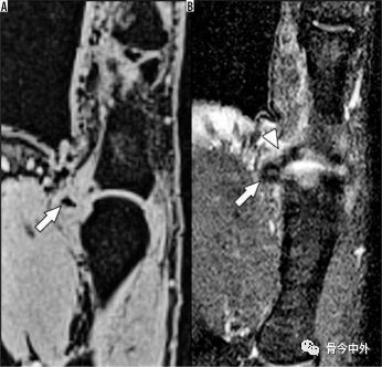 Latest Review: MRI Diagnostic Techniques for Little Finger and Thumb