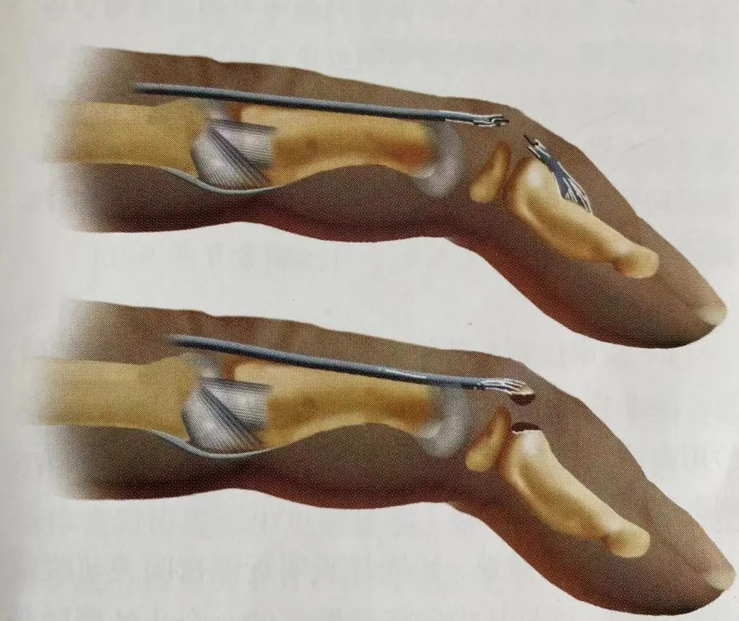 Comprehensive Summary: Treatment Strategies for Four Types of Hand Joint Injuries