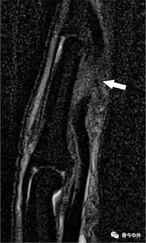 Latest Review: MRI Diagnostic Techniques for Little Finger and Thumb