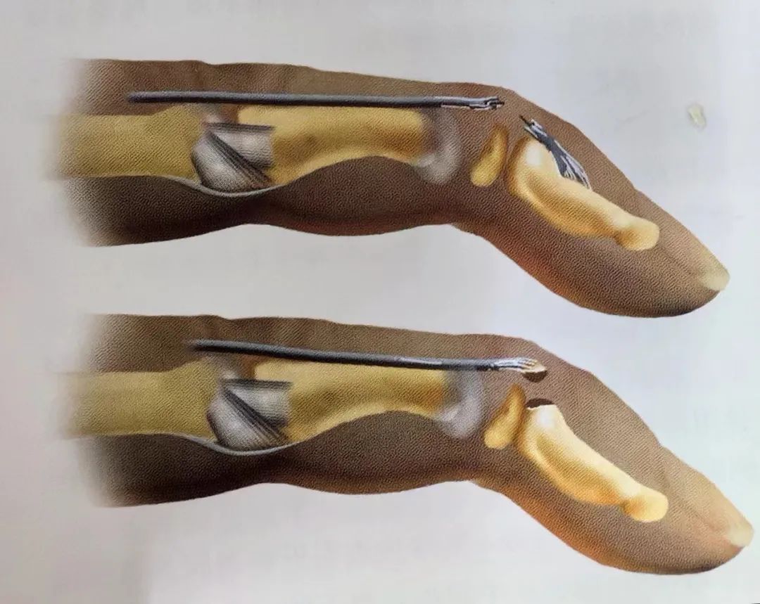 Key Points of Three Types of Hand Joint Injuries