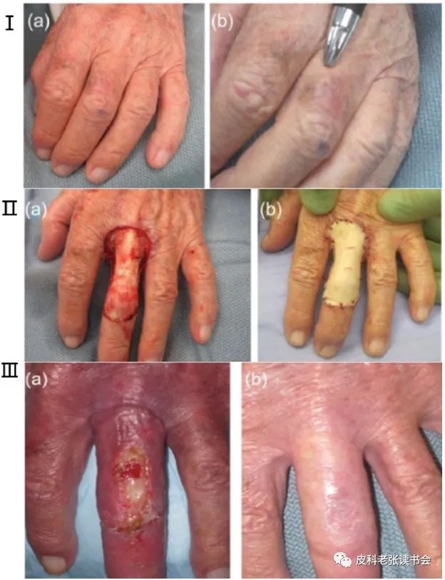 Merkel Cell Carcinoma Is Not Derived From Merkel Cells!