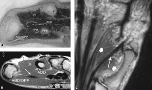 MRI of Finger Tendons