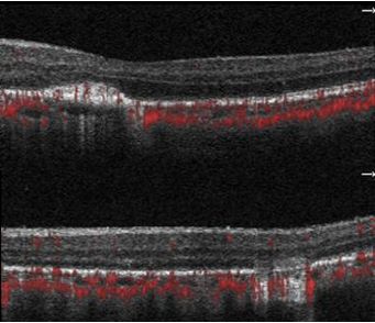 Understanding Multifocal Choroiditis Through Angio-OCT