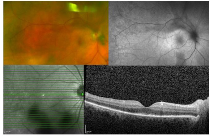 Comprehensive Guide to White Dot Syndromes