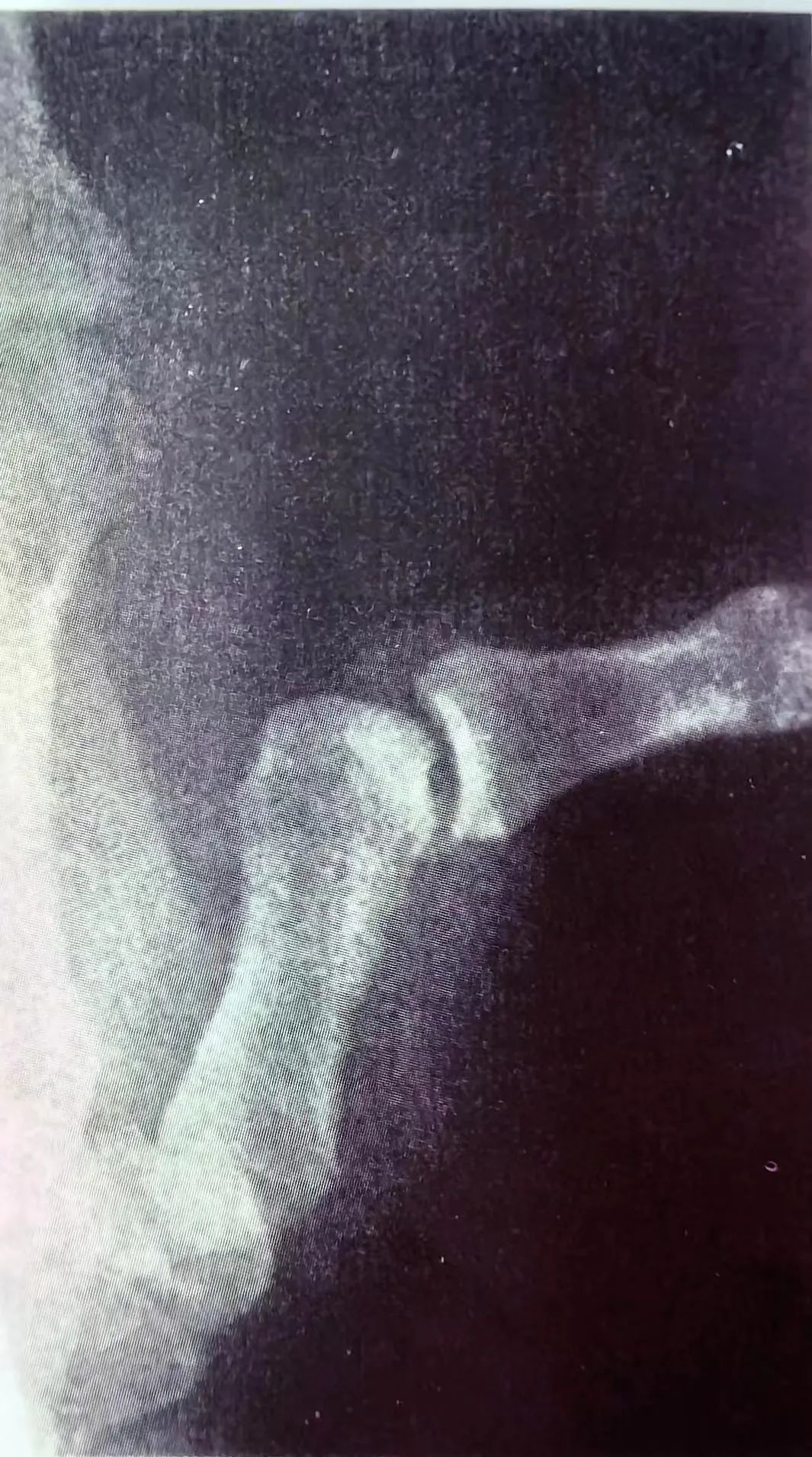 Key Points of Three Types of Hand Joint Injuries