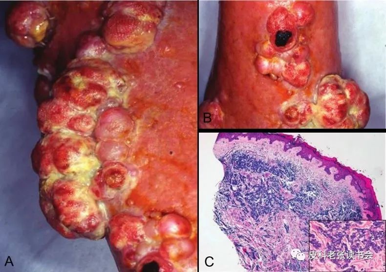 Merkel Cell Carcinoma Is Not Derived From Merkel Cells!
