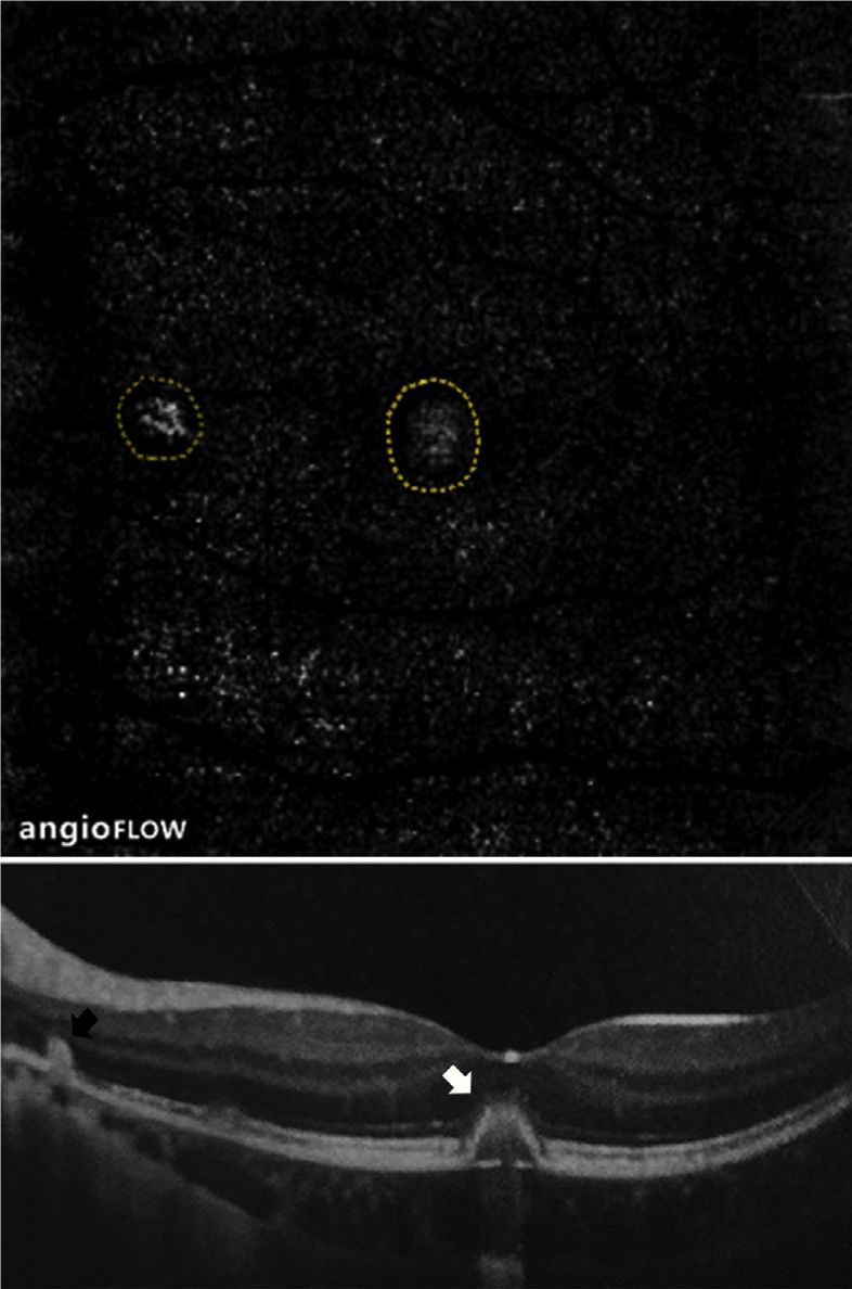 Understanding Multifocal Choroiditis Through Angio-OCT