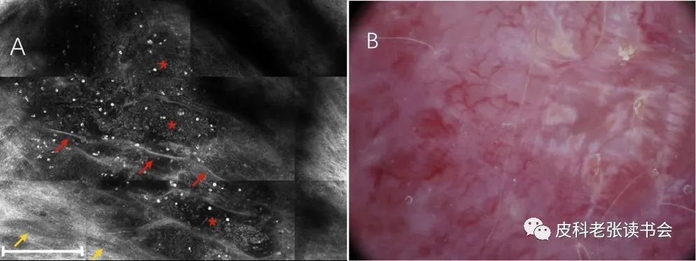 Merkel Cell Carcinoma Is Not Derived From Merkel Cells!