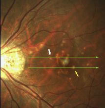 Understanding Multifocal Choroiditis Through Angio-OCT