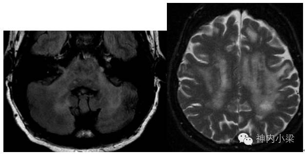Summary of Lesions in the Middle Cerebellar Peduncle