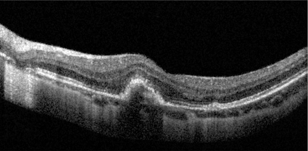 Understanding Multifocal Choroiditis Through Angio-OCT