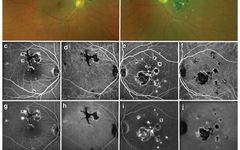 Comprehensive Guide to White Dot Syndromes