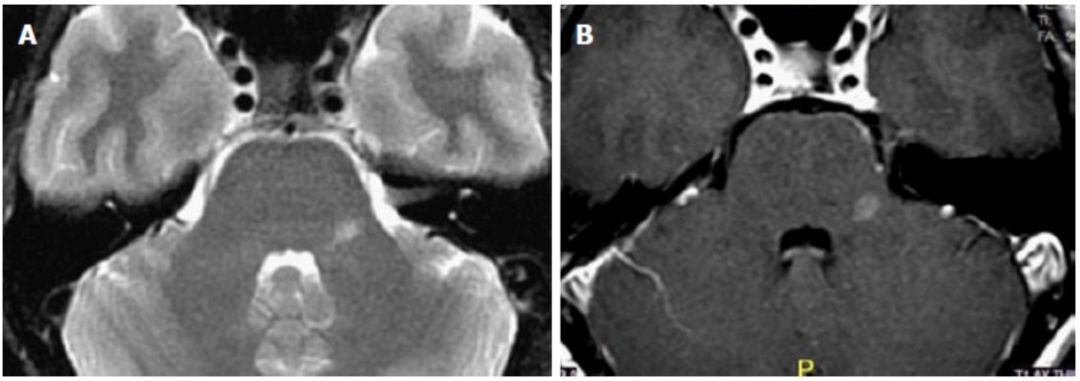 Exploring the Mystery of Middle Cerebellar Peduncles