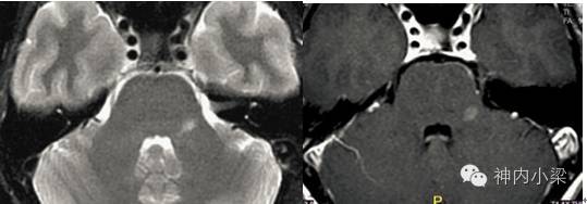 Summary of Lesions in the Middle Cerebellar Peduncle