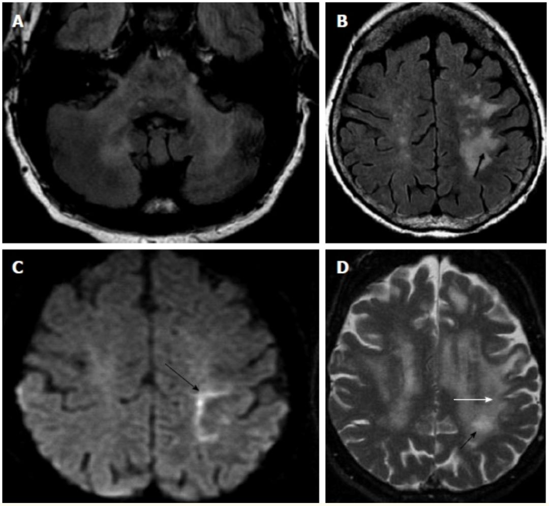 Exploring the Mystery of Middle Cerebellar Peduncles