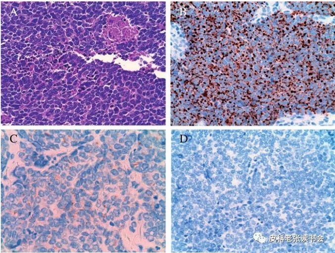 Merkel Cell Carcinoma Is Not Derived From Merkel Cells!