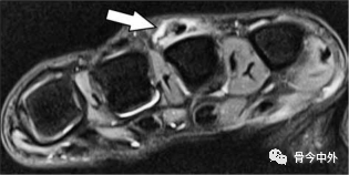 Latest Review: MRI Diagnostic Techniques for Little Finger and Thumb