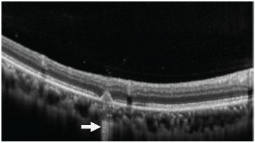 Understanding Multifocal Choroiditis Through Angio-OCT