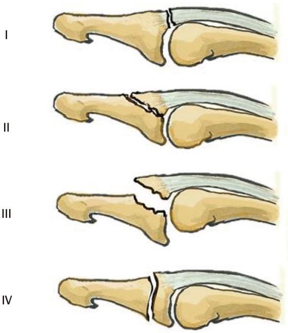 Key Points of Three Types of Hand Joint Injuries