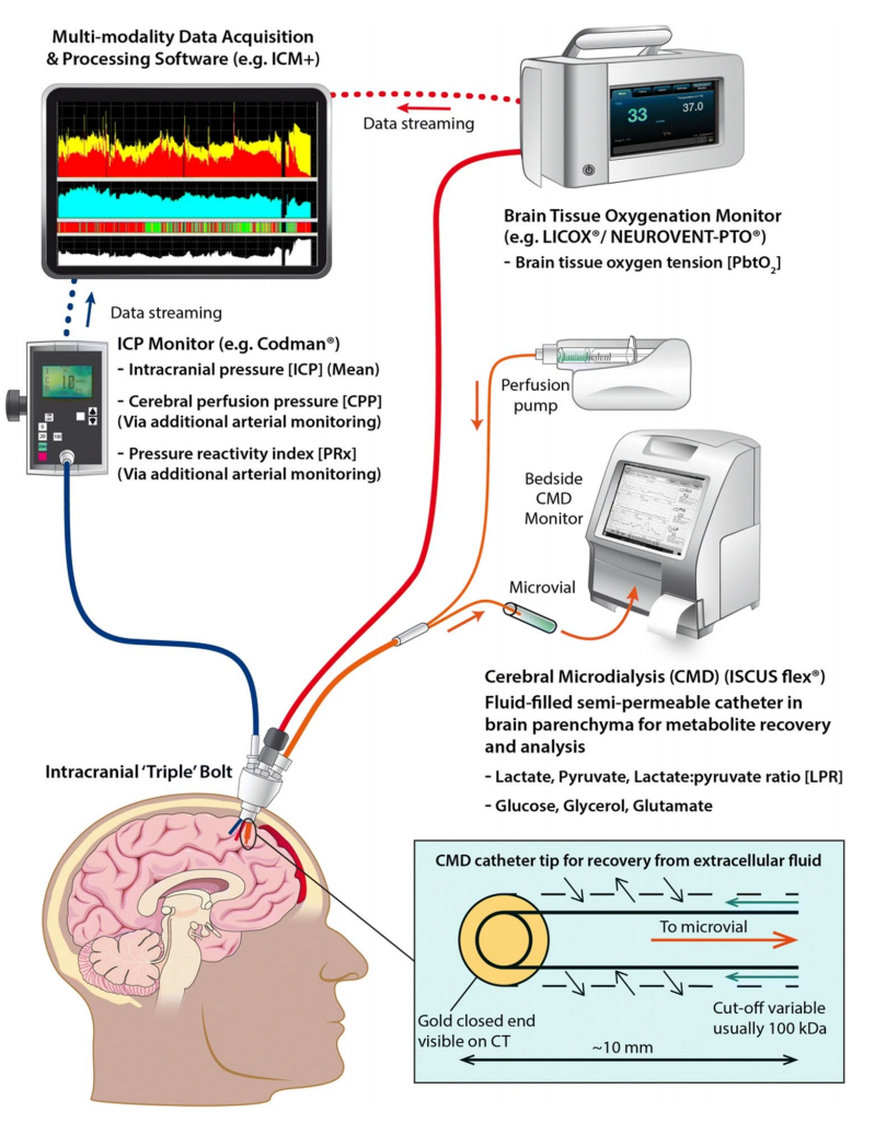Current State of High-Fidelity Multimodal Monitoring in Traumatic Brain Injury