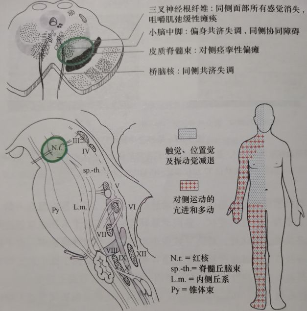 Claude Syndrome: Clinical Report and Analysis