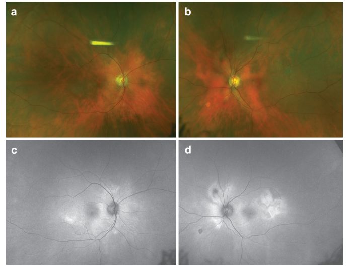 Comprehensive Guide to White Dot Syndromes