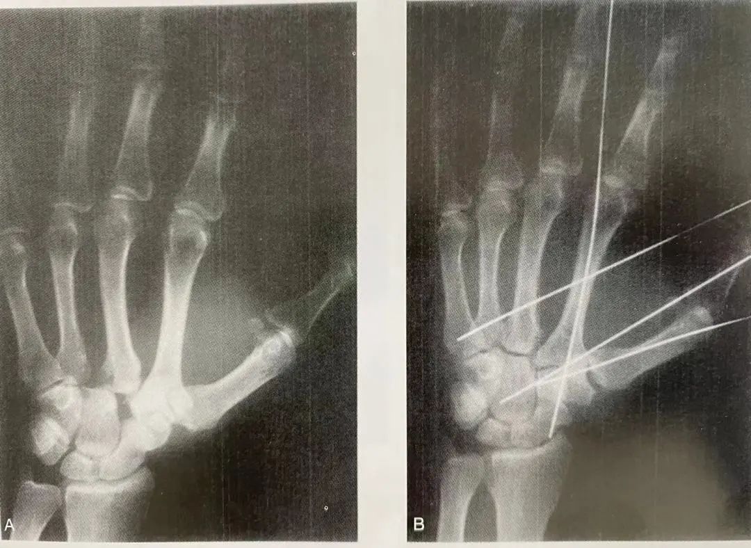 Comprehensive Summary: Treatment Strategies for Four Types of Hand Joint Injuries