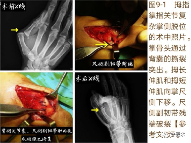 Key Points in the Diagnosis and Treatment of Metacarpophalangeal Joint Dislocation