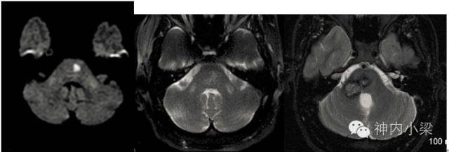 Summary of Lesions in the Middle Cerebellar Peduncle