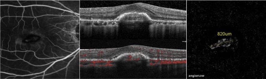 Understanding Multifocal Choroiditis Through Angio-OCT